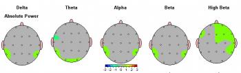 QEEG of typically developing child