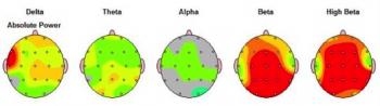 QEEG Elevated beta and High beta