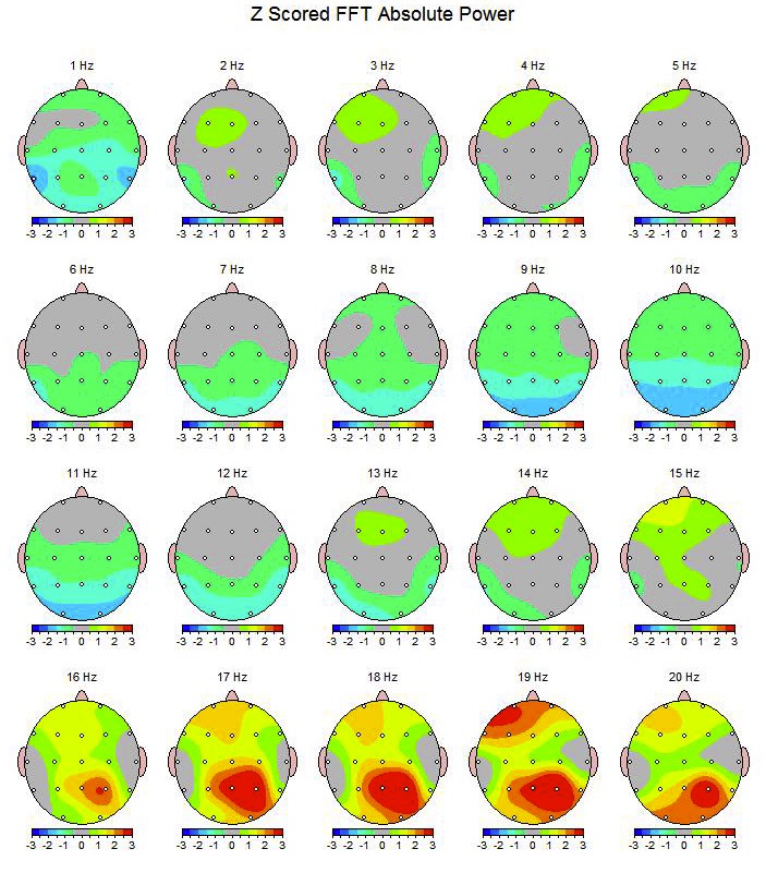 Quantitative EEG ADHD Test