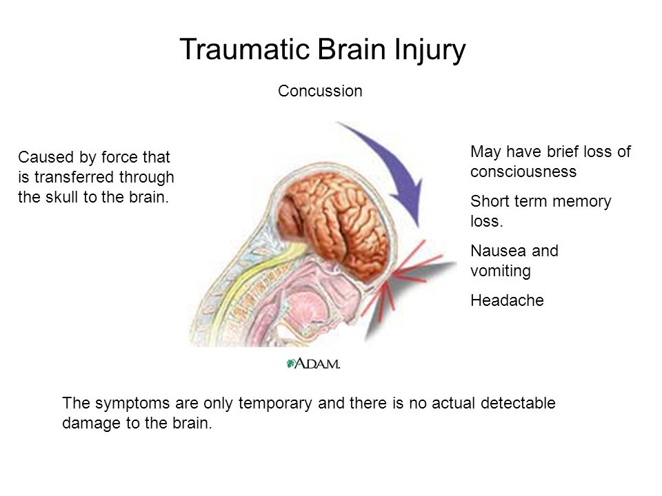 Minor closed head TBI